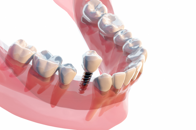 豊中市の歯医者、藤田歯科豊中ステーションクリニックのインプラント治療