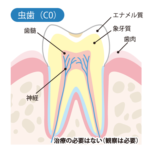 豊中市の歯医者、藤田歯科豊中ステーションクリニックでむし歯治療