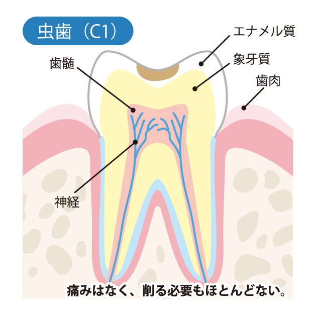 豊中市の歯医者、藤田歯科豊中ステーションクリニックでむし歯治療