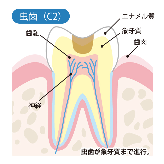 豊中市の歯医者、藤田歯科豊中ステーションクリニックでむし歯治療