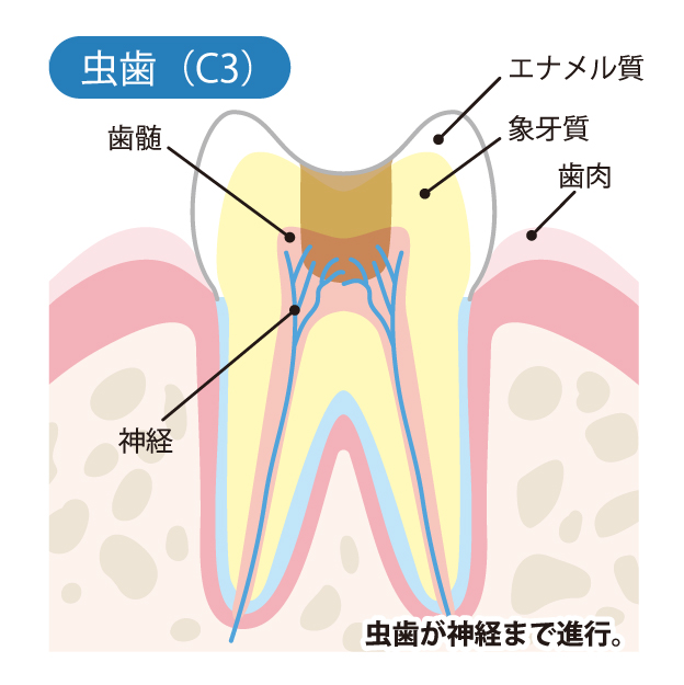 豊中市の歯医者、藤田歯科豊中ステーションクリニックでむし歯治療