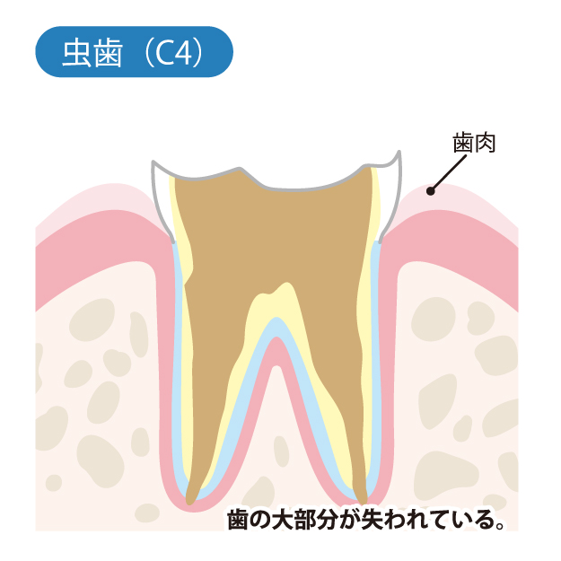 豊中市の歯医者、藤田歯科豊中ステーションクリニックでむし歯治療