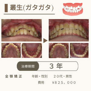豊中市の歯医者、藤田歯科豊中ステーションクリニックのマウスピース型矯正治療
