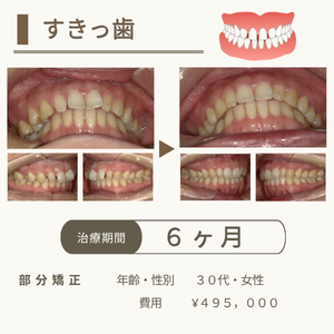 豊中市の歯医者、藤田歯科豊中ステーションクリニックのマウスピース型矯正治療