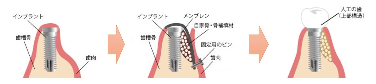 豊中市の歯医者、藤田歯科豊中ステーションクリニックのインプラント治療