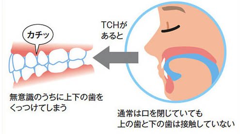 東大和市の歯医者の歯列接触癖対策